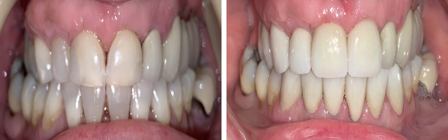 Partial Rehabilitation - Iona Dental