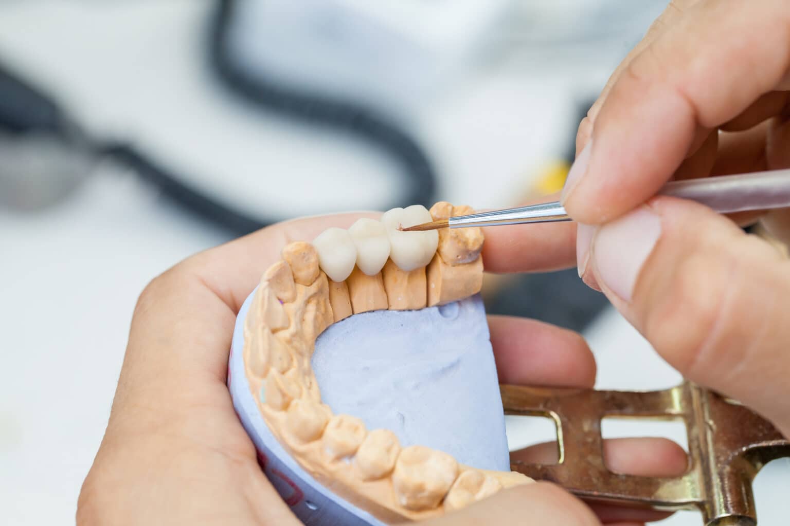 Dental Bridges in Mississauga