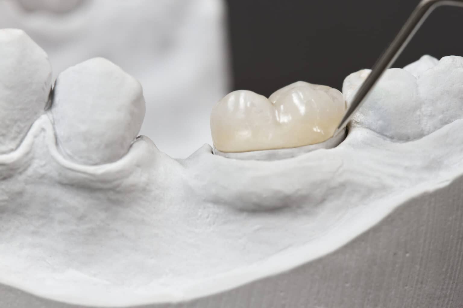 Dental Crowns in Mississauga