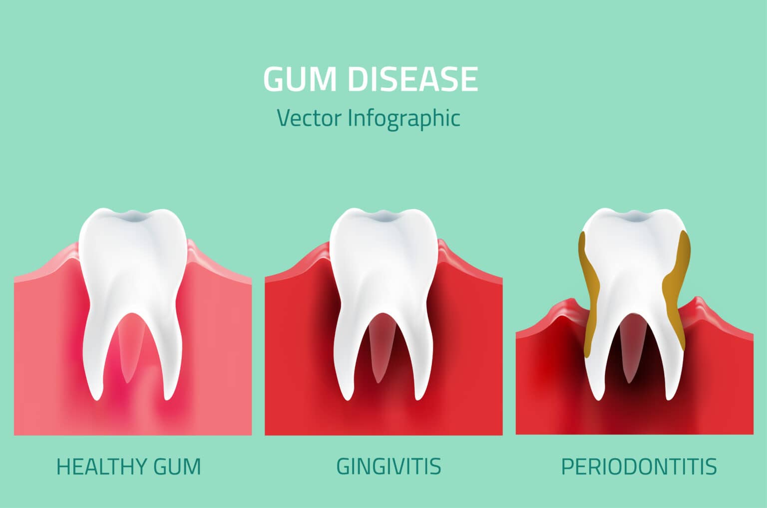 Periodontal Treatment in Mississauga