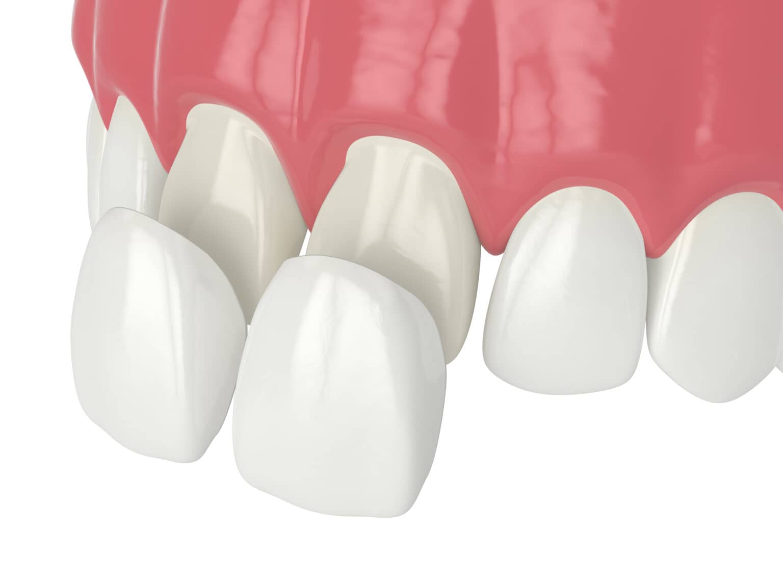 Porcelain Veneers in Mississauga