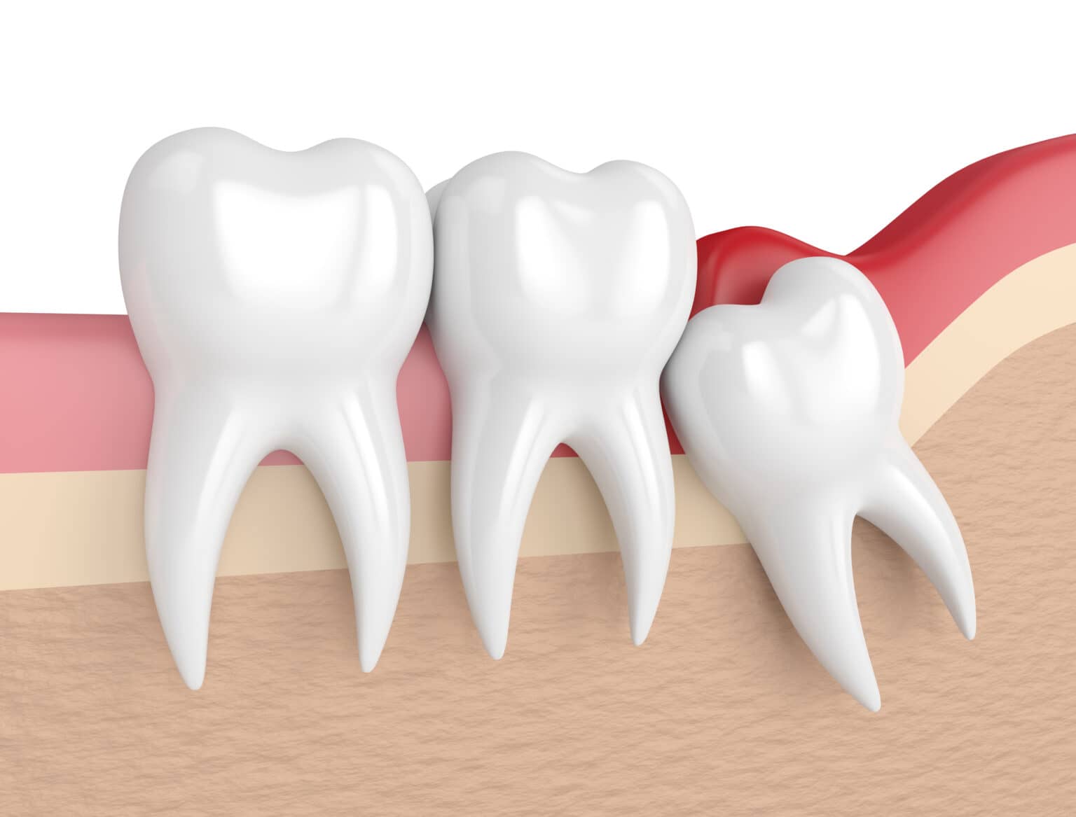 Wisdom Tooth Extractions in Mississauga